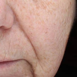 An image that shows a marked reduction in fine lines and brown posts following the NowMi treatment