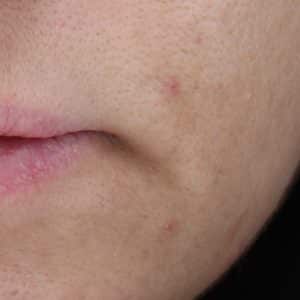 An image of the cheek and lip area of a young woman prior to the NowMi treatment