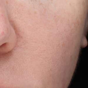 An picture of a young woman's cheek after 6 NowMi treatments. There is a marked reduction in the size of the pores and overall improvement of the skin.