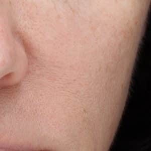 A picture of a young woman's cheek area before the NowMi treatment