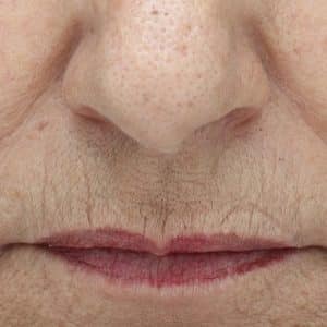 A picture of a mature woman's lips before the NowMi treatment