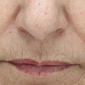 A picture of a woman's lip area following 6 NowMi treatments