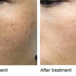 Skin lightening using the NowMi treatment