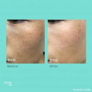 The NowMi treatment effectively treats acne
