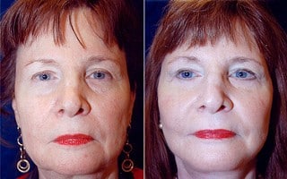 B&A of a woman after a facelift