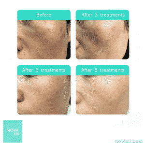 NowMi PRO skin oxygenation a whitening clinical results