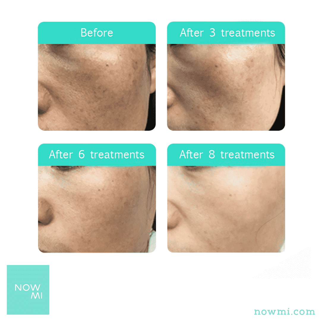 NowMi PRO clinical results