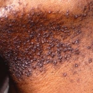 PFB on dark skin- can be treated with the NowMi device