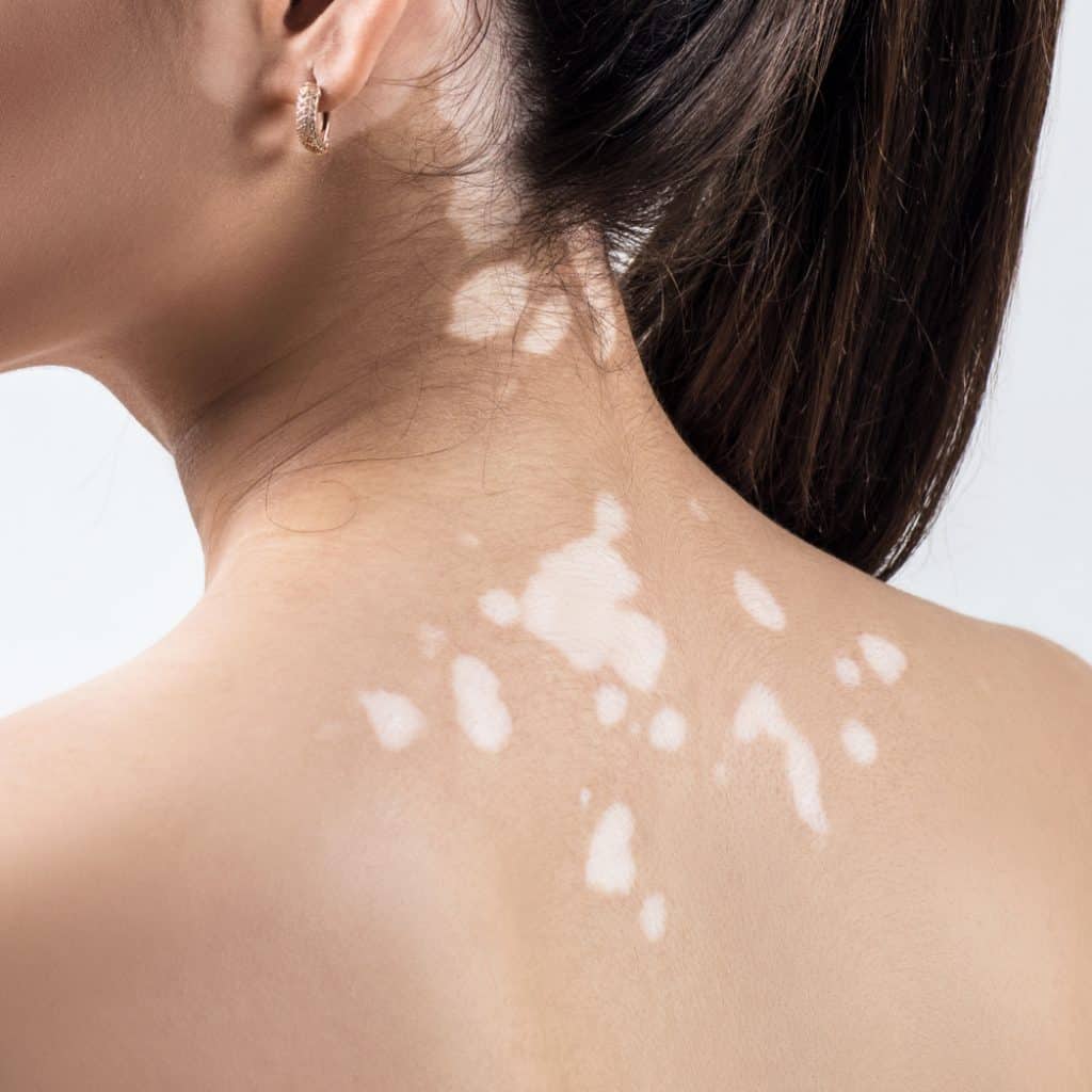 top 101+ Pictures pictures of white spots on skin Stunning