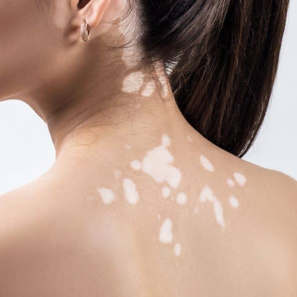 what-are-these-white-solar-spots-on-my-pores-and-skin-pretty-skin-pro