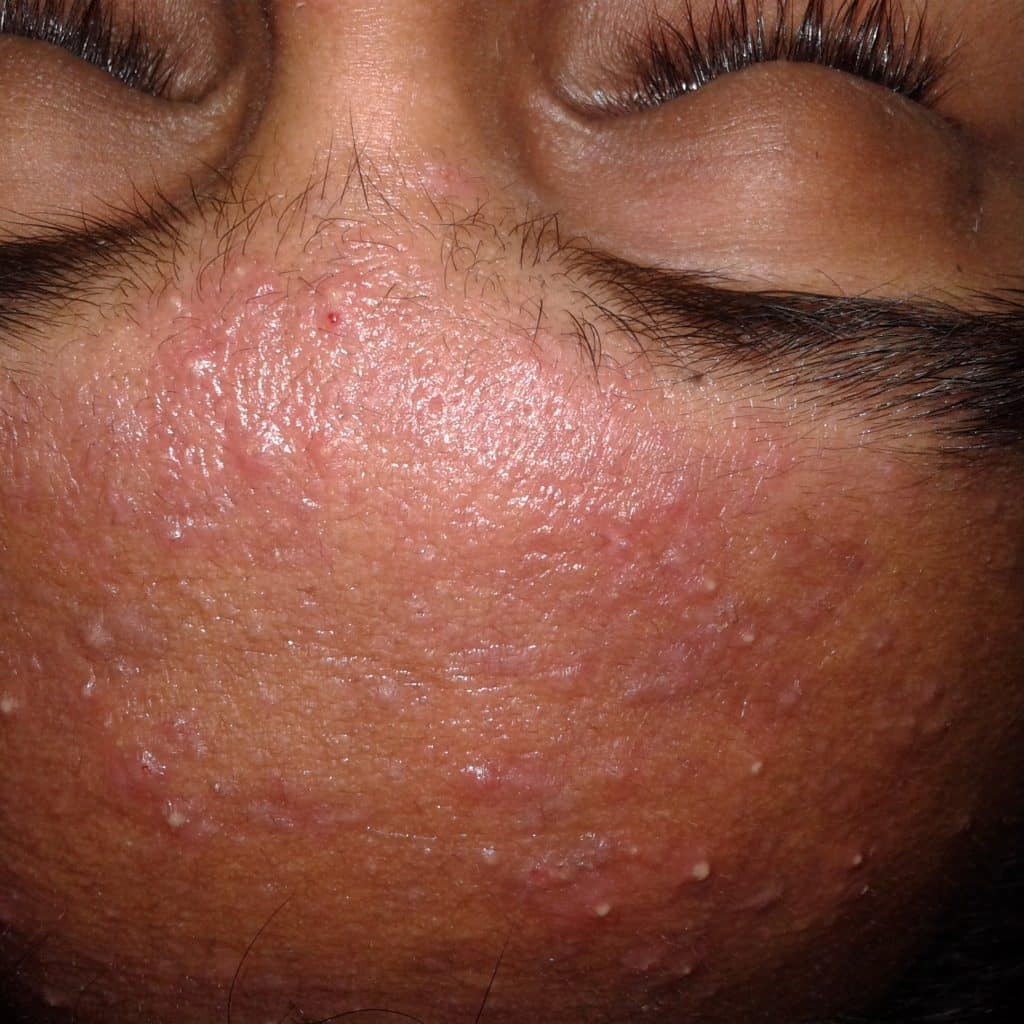 Acne vulgaris on very oily skin 