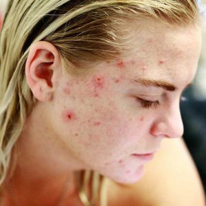 Acne treatment for sensitive skin | NowMi