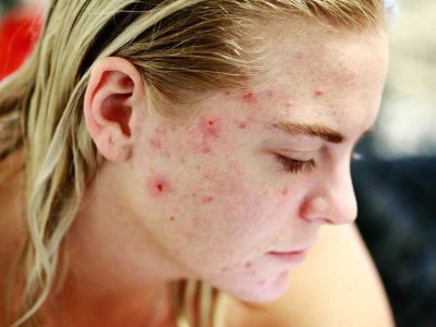 Acne treatment for sensitive skin | NowMi
